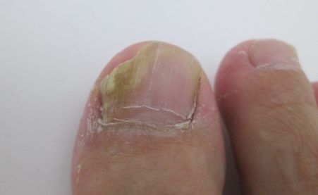 足の親指の水虫